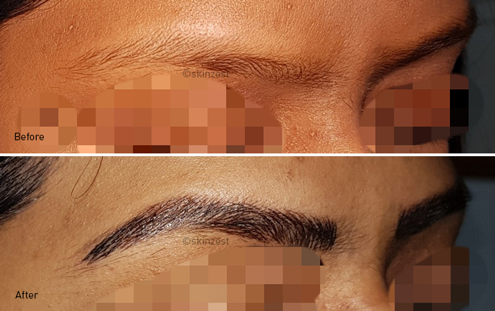 Eyebrow Reconstruction — before and after